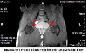 артроз суставов, тазобедренные суставы
