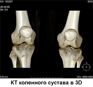 кт коленного сустава, реконструкция