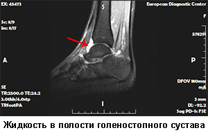 жидкость в голеностопном суставе